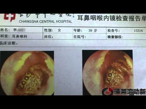 Doctor Finds Spider Inside Woman’s Ear Canal