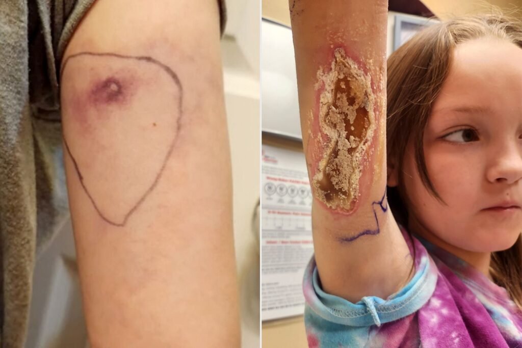 A 9-year-old girls harmless pinch turned out to be a dangerous spider bite